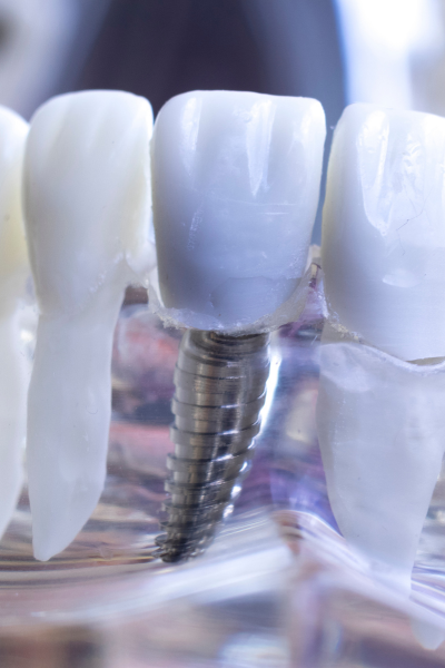 implant dentaire qui bouge