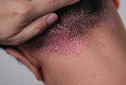 homme ayant du psoriasis sur le cuir chevelu