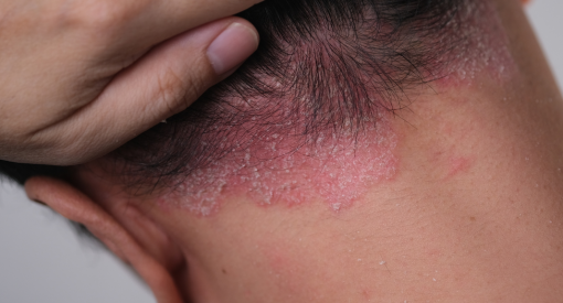 homme ayant du psoriasis sur le cuir chevelu