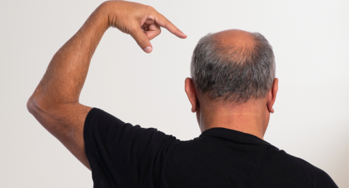 homme avec cheveux dégarnis sur le crâne (tonsure)