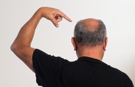 homme avec cheveux dégarnis sur le crâne (tonsure)