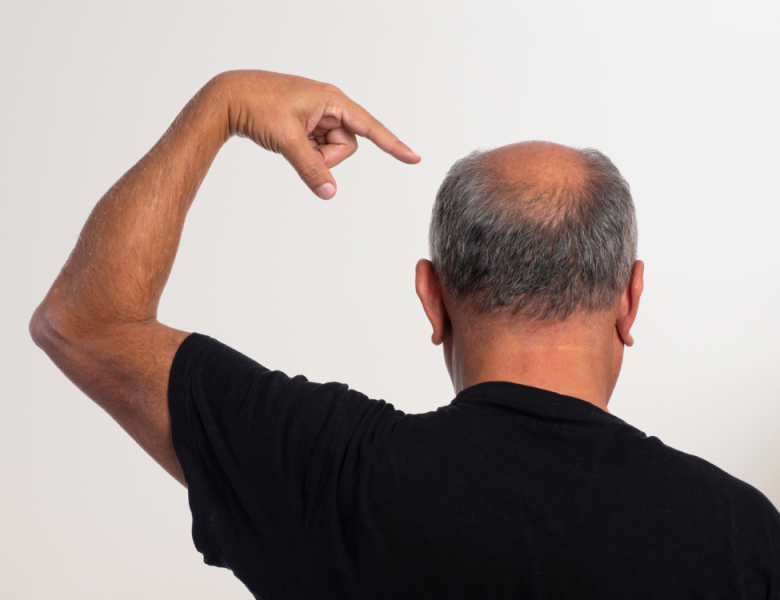 homme avec cheveux dégarnis sur le crâne (tonsure)