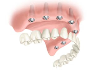 dentier fixe