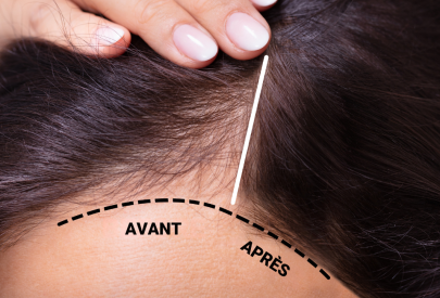 avant apres greffe de cheveux femme
