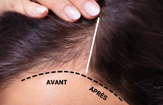 avant apres greffe de cheveux femme