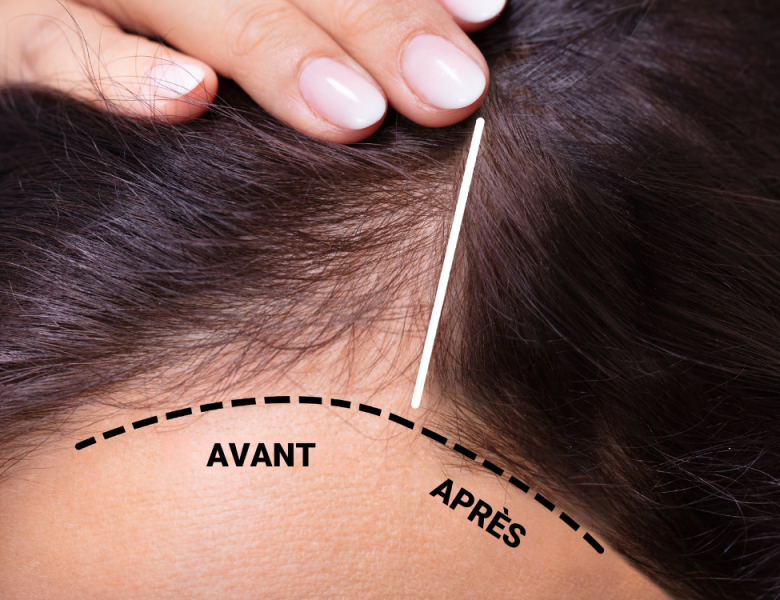 avant apres greffe de cheveux femme