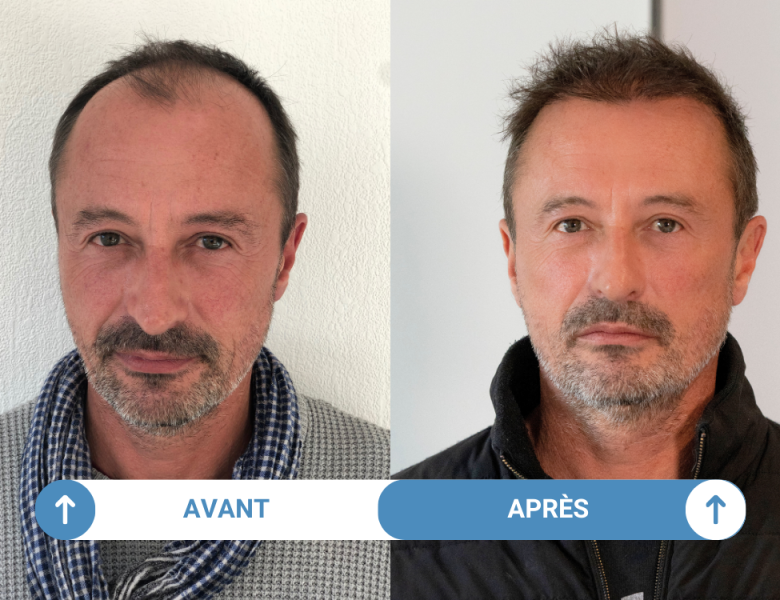 avant-apres-greffe-cheveux