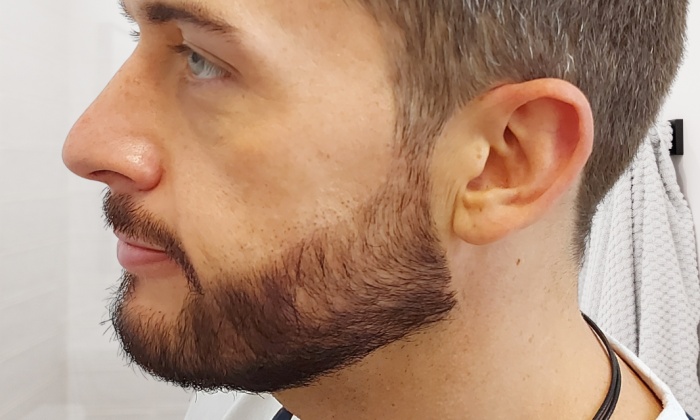 patient greffe barbe