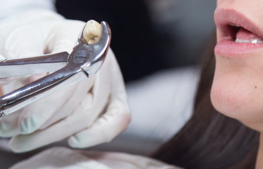 dentiste qui extrait une dent