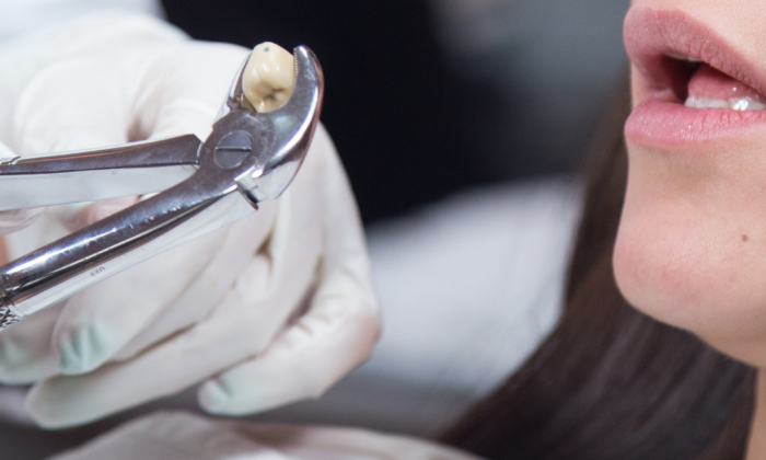 dentiste qui extrait une dent