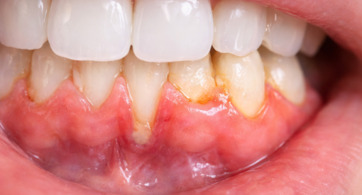 photo d'un déchaussement dentaire