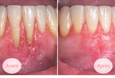 avant après traitement déchaussement des dents