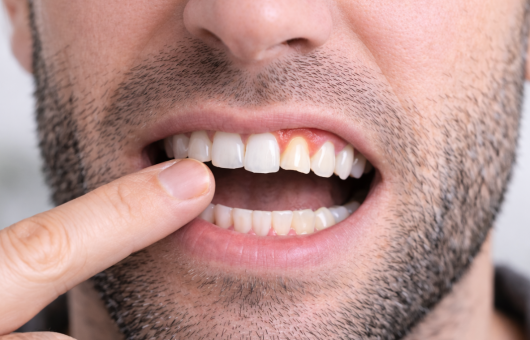 dent du haut qui se déchausse