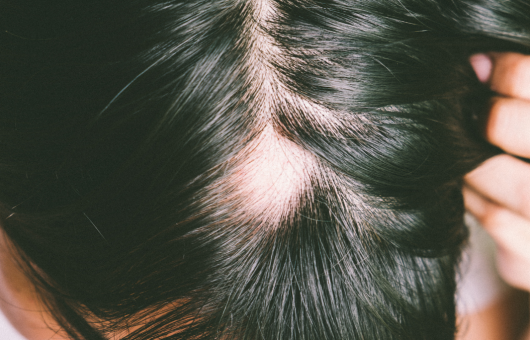 personne qui a une alopecie areata sur le crane, et cherche des réponses et solutions