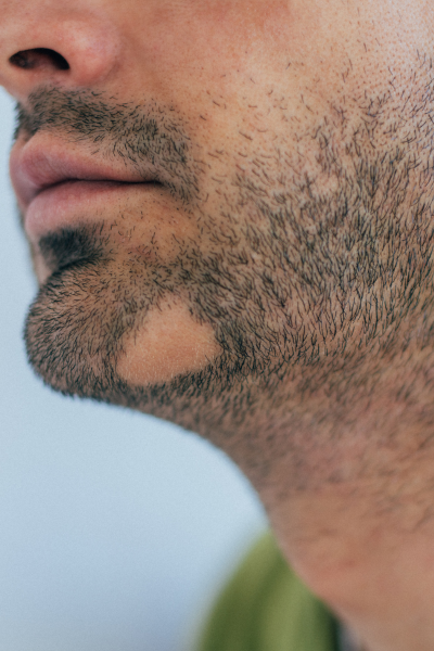 diagnostic alopecie areata pelade