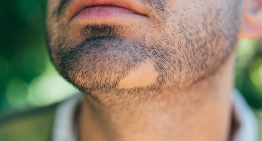 homme faisant face à un problème de pelade au niveau de sa barbe