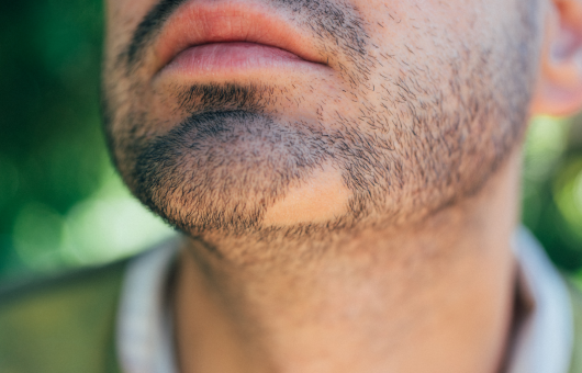 homme faisant face à un problème de pelade au niveau de sa barbe