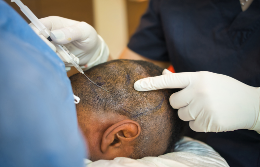 traitement mesotherapie ou led pour la perte de cheveux