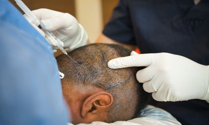 traitement mesotherapie ou led pour la perte de cheveux