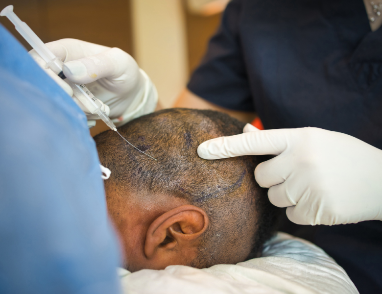 traitement mesotherapie ou led pour la perte de cheveux