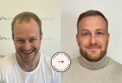 greffe de cheveux fabian