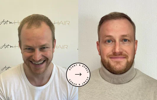 greffe de cheveux fabian