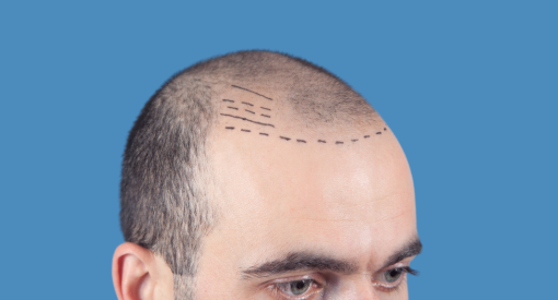 Micropigmentation capillaire sur un crâne dégarni