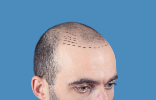 Micropigmentation capillaire sur un crâne dégarni