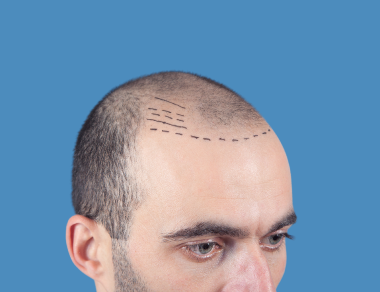 Micropigmentation capillaire sur un crâne dégarni